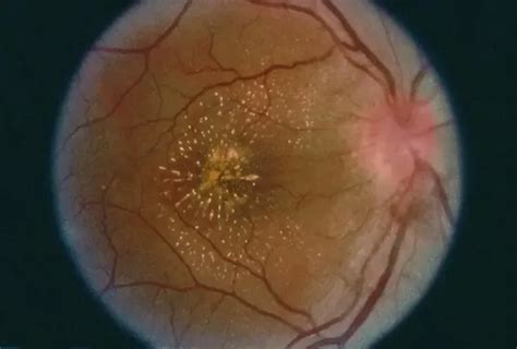 Ocular Tuberculosis (TB) - Middle East/North Africa - American Academy ...