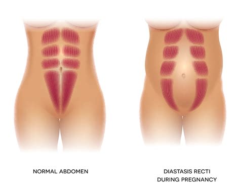 Abdominal separation - Peninsula Pelvic Floor Physiotherapy