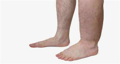 5 early warning signs and symptoms of elephantiasis - Read Health ...