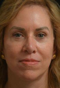 Facelift Before & After Beverly Hills & Los Angeles, CA