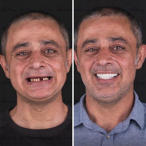 Best 13 How Soon After Tooth Extraction Can You Get Dental Implants