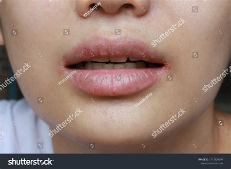 3,448 Lips cracked Images, Stock Photos & Vectors | Shutterstock