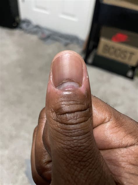 Damaged Nail Matrix Treatment