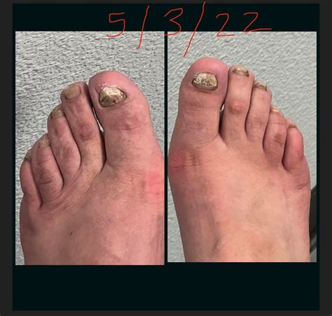 Terbinafine Progress: 4 months : r/NailFungus
