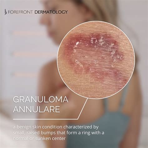 Forefront - Granuloma annulare is a skin condition that causes a raised