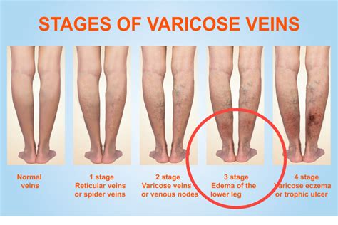 hidden dangers  varicose veins elite vein clinic
