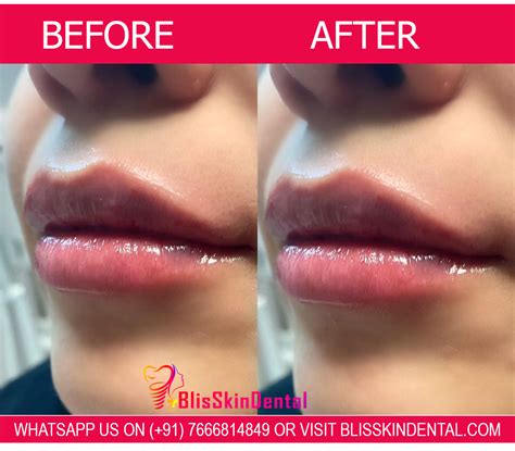 Benefits of Hyaluronic Acid Fillers for Fuller Lips