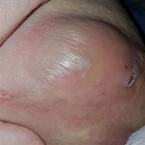 Hidradenitis Suppurativa Symptoms Huge Cheap | ids-deutschland.de