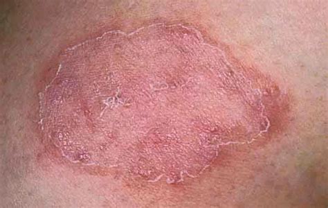 Ringworm In Adults