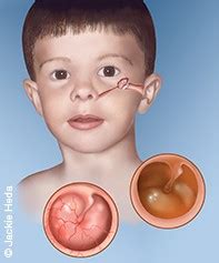 Acute otitis media in young children: diagnosis and management ...