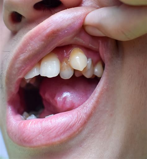 The Hidden Consequences of a Misaligned Bite - Call Today 855-614-5221