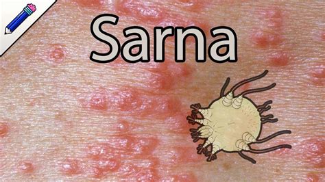 Como é Sarna Humana Fotos - BRAINCP