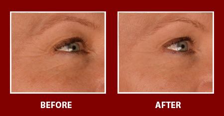 facemaster exclusive renew labdermasante