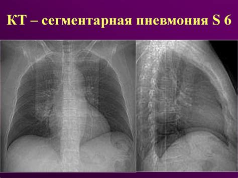 Рентгенодиагностика острой пневмонии у детей - презентация онлайн