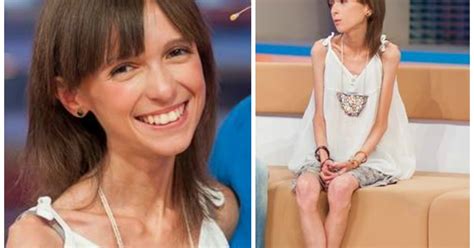 Самая худая девушка в Украине весит всего 25 кг - IVONA.UA