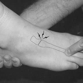 (PDF) The Piano Key Test: A Clinical Sign for the Identification of ...
