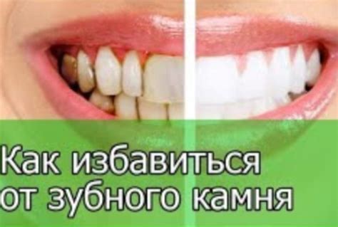 Как избавиться от зубного камня и осветлить пожелтевшую эмаль