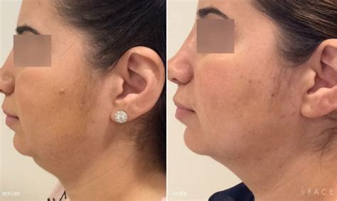 How Much Does Kybella® Cost? | Kybella Birmingham | Face Beauty Science