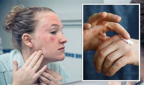 steroid cream expert issues warning  long term  side effect