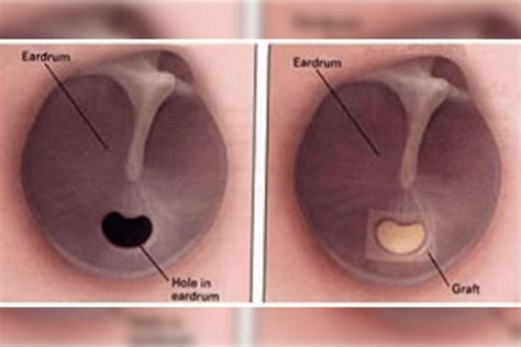 how to fix a ruptured ear drum