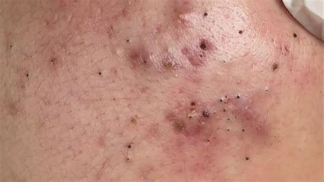 Best Pimples Popping Blackheads || 30/04/2021 #2 - YouTube