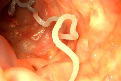 10 sintomas de vermes intestinais (com teste online) - Tua Saúde