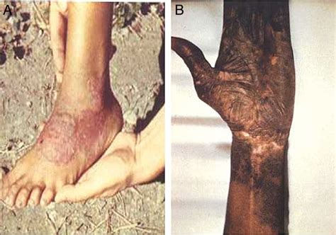 Endemic treponemal diseases - PMC