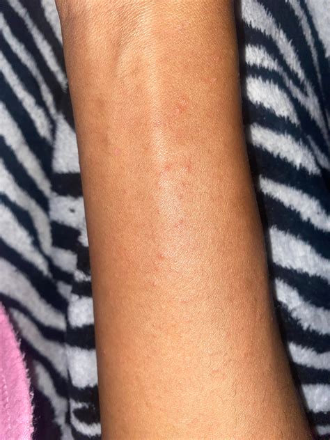 Common Skin Rashes On Arms _ Pictures Of Skin Rashes – ZIARLX