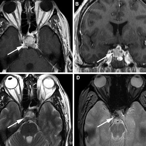 Acute on subacute pituitary apoplexy in a 42-year-old man presented ...