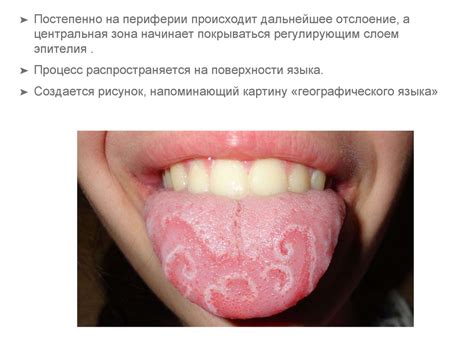 Десквамативный глоссит - online presentation