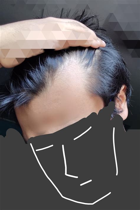 Men debate the best haircut for balding widows peak on social media 1