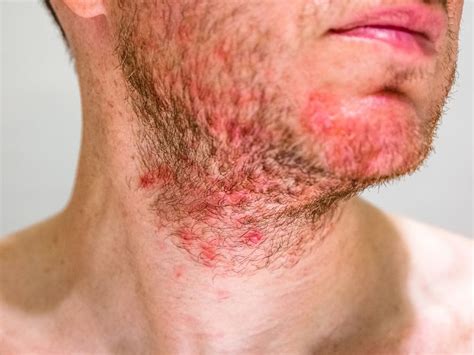 Alergia A Prestobarba