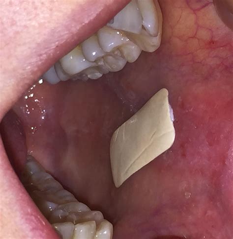 how to get rid of an ulcer in mouth 9