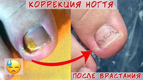 Коррекция вросшего ногтя после установки тампонады - YouTube