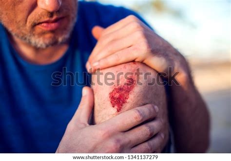 Infection Abrasion Skin Photos and Images & Pictures | Shutterstock