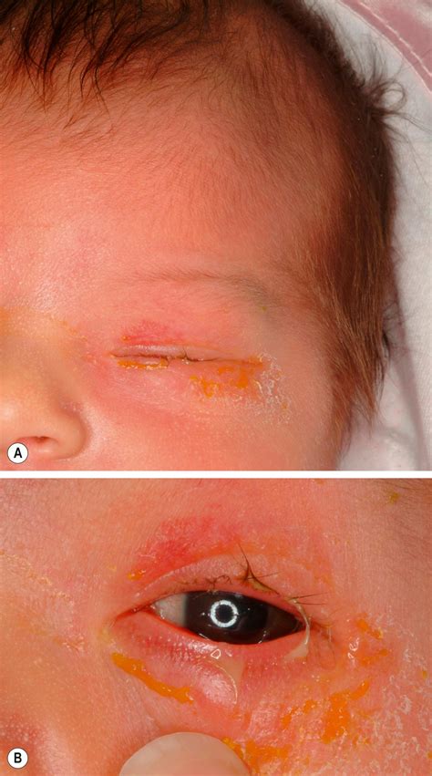 Chlamydia trachomatis - Clinical Tree