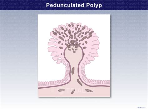 Pedunculated Polyp - TrialExhibits Inc.