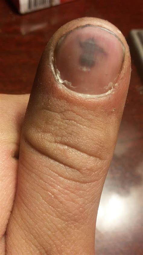 Infected Blood Blister On Finger