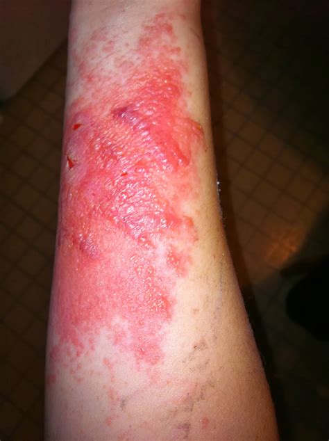 Poison ivy rash: Fact About Rash Symptoms & Treatment
