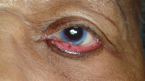 Ectropion: Symptoms, Causes, and Treatment