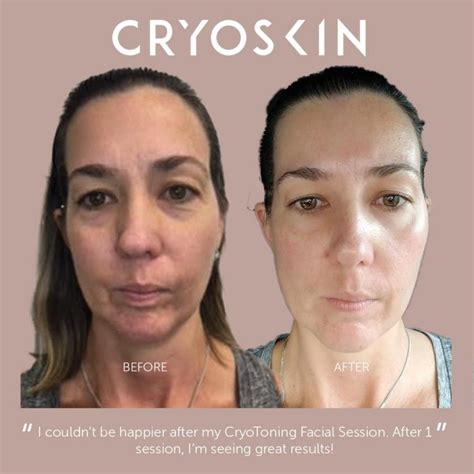 CryoSkin Before and After Photos - Simply Kneaded