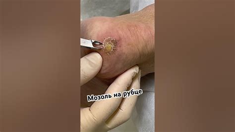 Торчащая мозоль на пятке #мозоли #подолог - YouTube