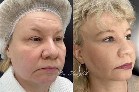 Эндоскопическая подтяжка лба и бровей в VIP Clinic. Цены на лифтинг ...