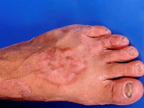Tinea Pedis Ulcerativa Aguda (PDF) #050. Gengivite Ulcerativa