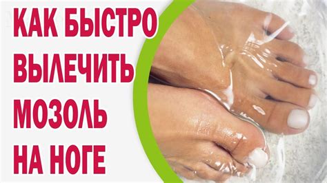 Как быстро вылечить мозоль на ноге - YouTube