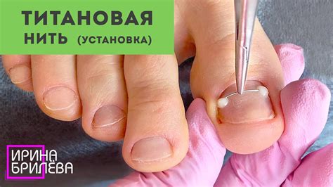 Установка ТИТАНОВОЙ НИТИ (NiTi) 🌸 Педикюр (убираем подногтевые мозоли ...