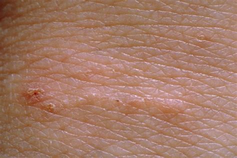 Niežai - Dermatologo konsultacija internetu - iDerma.lt