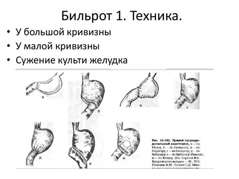 Резекция желудка по способу Бильрот 1 - презентация онлайн
