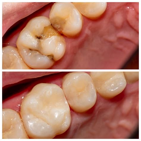 Cavity Filling Before And After
