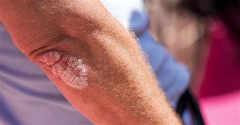 chronic plaque psoriasis symptoms treatment